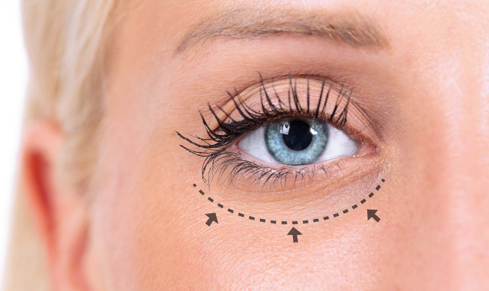 Plastická operace dolních očních víček