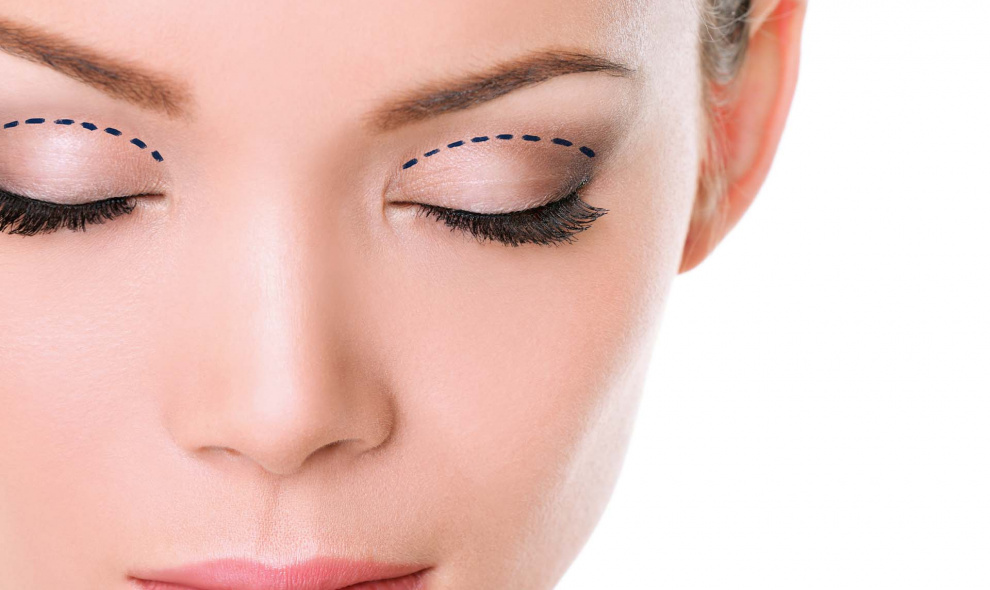 Plastická operácia horných očných viečok